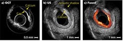 FIGURE 3. OCT (a), ultrasound (b), and combined OCT and ultrasound (c) images are shown for a human coronary artery specimen. Arrows show the location of artery plaque caps that can cause blockages. The contours of the vessel in the OCT and ultrasound images match well with each other, indicating that the two images were taken at the same site. The radius of the image is 4.5 mm.