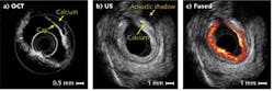 FIGURE 3. OCT (a), ultrasound (b), and combined OCT and ultrasound (c) images are shown for a human coronary artery specimen. Arrows show the location of artery plaque caps that can cause blockages. The contours of the vessel in the OCT and ultrasound images match well with each other, indicating that the two images were taken at the same site. The radius of the image is 4.5 mm. FIGURE 3. OCT (a), ultrasound (b), and combined OCT and ultrasound (c) images are shown for a human coronary artery specimen. Arrows show the location of artery plaque caps that can cause blockages. The contours of the vessel in the OCT and ultrasound images match well with each other, indicating that the two images were taken at the same site. The radius of the image is 4.5 mm.