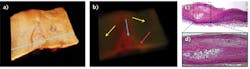 FIGURE 4. An (a) OCT image, (b) an acoustic radiation force optical coherence elastography (ARF-OCE) phase image, and (c) a histological image corresponding to the blue line in (a), and a closeup of an atherosclerotic lesion (d) are shown for a human coronary artery under 500 Hz, 200 mV sine-wave excitation bursts. The red-colored region indicated by the blue arrow in (b) is characterized by smaller phase and less vibration and represents less elastic, stiffer tissue such as atherosclerotic plaques. The stronger vibration representing softer tissue (dark area) is indicated by yellow arrows. The stiffer tissue corresponds to an atherosclerotic lesion in the blue box in the histological image and is clearly distinguishable from the softer (normal) tissue area. The transition between plaque and normal regions appears orange in color (indicated by the red arrow) and is characterized by intermediate elasticity. FIGURE 4. An (a) OCT image, (b) an acoustic radiation force optical coherence elastography (ARF-OCE) phase image, and (c) a histological image corresponding to the blue line in (a), and a closeup of an atherosclerotic lesion (d) are shown for a human coronary artery under 500 Hz, 200 mV sine-wave excitation bursts. The red-colored region indicated by the blue arrow in (b) is characterized by smaller phase and less vibration and represents less elastic, stiffer tissue such as atherosclerotic plaques. The stronger vibration representing softer tissue (dark area) is indicated by yellow arrows. The stiffer tissue corresponds to an atherosclerotic lesion in the blue box in the histological image and is clearly distinguishable from the softer (normal) tissue area. The transition between plaque and normal regions appears orange in color (indicated by the red arrow) and is characterized by intermediate elasticity.