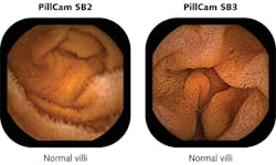 FIGURE 1. Villi in the small intestine are imaged with the PillCam SB 2 and compared to the newest generation PillCam SB 3, which has 30% improved resolution. FIGURE 1. Villi in the small intestine are imaged with the PillCam SB 2 and compared to the newest generation PillCam SB 3, which has 30% improved resolution.