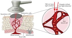 Noninvasive laser Doppler scanning of vasculature beneath moles has enabled detection of markers indicating melanoma.