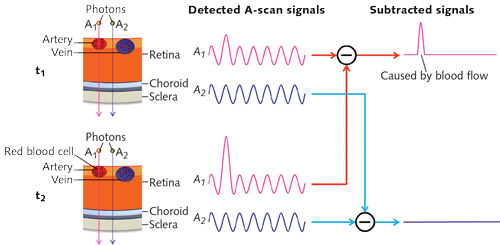 FIGURE 1. How OCTA works: As moving blood cells pass through vessels, they generate changes in OCT signals. Based on this concept, a blood flow signal can be extracted by subtracting the OCT signals from the same location but at different time points (red path). The OCT signals will be different at these locations, while OCT signals from surrounding retinal tissues will remain steady (blue path).