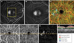 FIGURE 3. Optical microangiography (OMAG) and fluorescein angiography (FA) images illustrate intermediate, non-proliferative MacTel2. (a) An early-phase FA image shows hyperfluorescence in the temporal juxtafoveal region, while (b) a late-phase FA image shows increased and diffuse hyperfluorescence and leakage. (c) A composite en face color-coded OMAG demonstrates abnormalities that correspond well to the microvascular abnormalities seen in the early-stage FA image. (d) An en face OMAG image from the superficial retinal layer shows microvascular abnormalities in the juxtafoveal region, while (e) an en face OMAG from the deep retinal layer shows the telangiectatic and dilated vessels in the middle retinal layers. (f) And an en face OMAG image from the outer retinal layer shows subtle microvascular alterations in the outer retinal layers. (g) Finally, a horizontal central B-scan shows the microvascular flow in different colors corresponding to the different segmented layers of the retina. Thinning of the retina and disruption of the inner segment/outer segment/ellipsoid boundary are observed temporally in an area of abnormal retinal flow (green and blue). The size of (c-f) is 3 &times; 3 mm2.