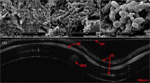 Images from endotracheal tubes: 5000&times; SEM image of 120-h postintubation endotracheal tube showing the presence of extracellular polymeric substrate (a); 5000&times; SEM image of same endotracheal tube in a different location (b); 15,000&times; SEM of same endotracheal tube focusing in on a cluster of cells (c); and corresponding OCT image (d).