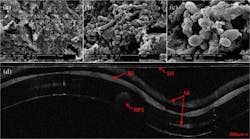 Images from endotracheal tubes: 5000× SEM image of 120-h postintubation endotracheal tube showing the presence of extracellular polymeric substrate (a); 5000× SEM image of same endotracheal tube in a different location (b); 15,000× SEM of same endotracheal tube focusing in on a cluster of cells (c); and corresponding OCT image (d). Images from endotracheal tubes: 5000× SEM image of 120-h postintubation endotracheal tube showing the presence of extracellular polymeric substrate (a); 5000× SEM image of same endotracheal tube in a different location (b); 15,000× SEM of same endotracheal tube focusing in on a cluster of cells (c); and corresponding OCT image (d).