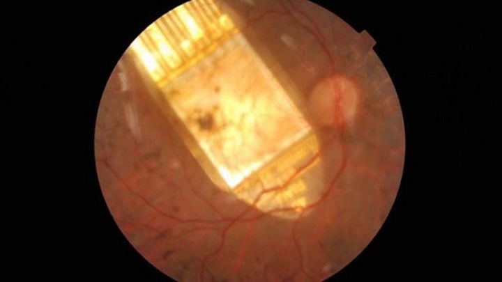 The retinal implant is in place in the patient's eye. (Image credit: University of Oxford)
