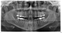 FIGURE 3. For dental x-ray scans, TDI CCD arrays offer excellent image quality.