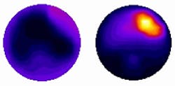 FIGURE 3. Diffuse optical spectroscopy looks at hemoglobin concentrations and level of tissue oxygenation to distinguish cancerous tissue from healthy tissue with an average specificity of 89%. This image shows slices across 3D reconstructions of the hemoglobin concentration in the left and right breast of a 58-year-old woman with Grade II invasive carcinoma in the upper outer quadrant of the left breast. FIGURE 3. Diffuse optical spectroscopy looks at hemoglobin concentrations and level of tissue oxygenation to distinguish cancerous tissue from healthy tissue with an average specificity of 89%. This image shows slices across 3D reconstructions of the hemoglobin concentration in the left and right breast of a 58-year-old woman with Grade II invasive carcinoma in the upper outer quadrant of the left breast.