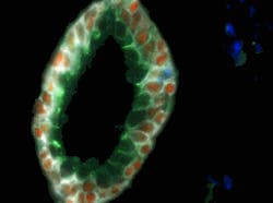 FIGURE 5. Fluorescent quantum dots (QDs) target the antibodies of certain cells and can be observed using a spectral imaging microscope. In this case, a single malignant prostate cancer cell (in blue) is identified among healthy proteins and cells (red, green, white) in the wall of a prostate gland. FIGURE 5. Fluorescent quantum dots (QDs) target the antibodies of certain cells and can be observed using a spectral imaging microscope. In this case, a single malignant prostate cancer cell (in blue) is identified among healthy proteins and cells (red, green, white) in the wall of a prostate gland.