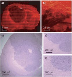 FIGURE 4. Coherent anti-Stokes Raman scattering (CARS) provides label-free, in-situ visualization of the margins of a mouse tumor (dark area in upper left image); it also allows extreme closeup imaging of the same tumor (area in white square). The method compares favorably with conventional stained tissue slices of another mouse with a brain tumor, with normal tissue (pink) and cancerous tissue (purple) clearly identified; however, the mouse was sacrificed to obtain the image. FIGURE 4. Coherent anti-Stokes Raman scattering (CARS) provides label-free, in-situ visualization of the margins of a mouse tumor (dark area in upper left image); it also allows extreme closeup imaging of the same tumor (area in white square). The method compares favorably with conventional stained tissue slices of another mouse with a brain tumor, with normal tissue (pink) and cancerous tissue (purple) clearly identified; however, the mouse was sacrificed to obtain the image.