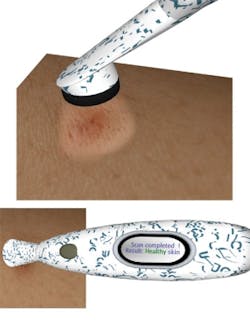 FIGURE 4. A proposed visionary consumer health device uses a compact hyperspectral module to check skin health. Moles, freckles, or burns are scanned and analyzed and the user is informed of the risk for melanoma and is instructed to contact a doctor if needed.