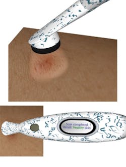 FIGURE 4. A proposed visionary consumer health device uses a compact hyperspectral module to check skin health. Moles, freckles, or burns are scanned and analyzed and the user is informed of the risk for melanoma and is instructed to contact a doctor if needed. FIGURE 4. A proposed visionary consumer health device uses a compact hyperspectral module to check skin health. Moles, freckles, or burns are scanned and analyzed and the user is informed of the risk for melanoma and is instructed to contact a doctor if needed.