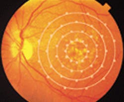 FIGURE 1. During treatment for age-related macular degeneration, 48 diode-laser lesions of 125 µm were applied in four concentric circles outside the foveal avascular zone of the eye in a scatter or grid pattern between 750 and 2250 µm from the center of the zone. FIGURE 1. During treatment for age-related macular degeneration, 48 diode-laser lesions of 125 µm were applied in four concentric circles outside the foveal avascular zone of the eye in a scatter or grid pattern between 750 and 2250 µm from the center of the zone.