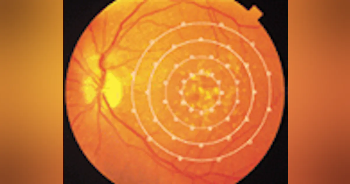 Medicalwatch: AMD and wavefront analysis highlight ophthalmology ...