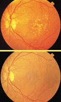 FIGURE 2. Effects of age-related macular degeneration in a 63-year-old woman include soft drusen beneath the fovea and visual acuity decreased to 20/50-2 (top). Nine months following laser treatment, her drusen have almost completely disappeared, and her visual acuity improved to 20/20. Note the absence of visible signs of laser treatment. FIGURE 2. Effects of age-related macular degeneration in a 63-year-old woman include soft drusen beneath the fovea and visual acuity decreased to 20/50-2 (top). Nine months following laser treatment, her drusen have almost completely disappeared, and her visual acuity improved to 20/20. Note the absence of visible signs of laser treatment.