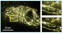 FIGURE 2. When a femtosecond laser pulse is tightly focused into a nearly transparent biological material, energy is deposited by nonlinear absorption only in the focus where laser intensity is high, resulting in disruption of the structure in the focal volume. Researchers at Harvard University have used this technique to manipulate subcellular structures; for example, in a live endothelial cell with fluorescently tagged mitochondria (inset), femtosecond laser pulses removed one of three very closely spaced mitochondria (arrow) without affecting nearby cells. FIGURE 2. When a femtosecond laser pulse is tightly focused into a nearly transparent biological material, energy is deposited by nonlinear absorption only in the focus where laser intensity is high, resulting in disruption of the structure in the focal volume. Researchers at Harvard University have used this technique to manipulate subcellular structures; for example, in a live endothelial cell with fluorescently tagged mitochondria (inset), femtosecond laser pulses removed one of three very closely spaced mitochondria (arrow) without affecting nearby cells.