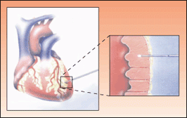 Transmyocardial revascularization, or TMR, is a treatment for the pain caused by coronary heart disease. Pulses from a CO2 laser timed to the heart beat to drill small holes through the heart wall.