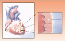 Transmyocardial revascularization, or TMR, is a treatment for the pain caused by coronary heart disease. Pulses from a CO2 laser timed to the heart beat to drill small holes through the heart wall. Transmyocardial revascularization, or TMR, is a treatment for the pain caused by coronary heart disease. Pulses from a CO2 laser timed to the heart beat to drill small holes through the heart wall.