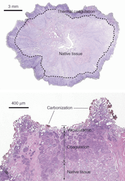 FIGURE 1. Using a 110-W thulium fiber laser operating at 1.9 &micro;m, researchers rapidly vaporized prostate tissue at a rate of 0.83 &PlusMinus; 0.11 g/min and with a thermal coagulation zone of 500 to 2000 &micro;m, demonstrating the potential for hemostasis.