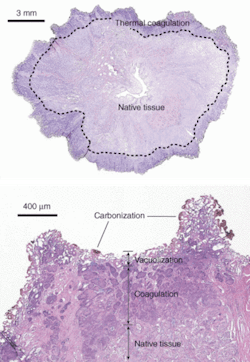 FIGURE 1. Using a 110-W thulium fiber laser operating at 1.9 µm, researchers rapidly vaporized prostate tissue at a rate of 0.83 ± 0.11 g/min and with a thermal coagulation zone of 500 to 2000 µm, demonstrating the potential for hemostasis. FIGURE 1. Using a 110-W thulium fiber laser operating at 1.9 µm, researchers rapidly vaporized prostate tissue at a rate of 0.83 ± 0.11 g/min and with a thermal coagulation zone of 500 to 2000 µm, demonstrating the potential for hemostasis.