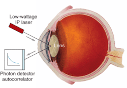 Quasi-elastic light-scattering may allow early diagnosis of Alzheimer's disease by detecting protein aggregates at the internal periphery of the lens. Quasi-elastic light-scattering may allow early diagnosis of Alzheimer's disease by detecting protein aggregates at the internal periphery of the lens.