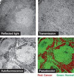FIGURE 1. Unstained lymph nodes from consenting patients were microscopically imaged. Reflectance and transmittance were unremarkable. Wavelength-optimized autofluorescence (bottom left) was most effective in detecting the spread of cancer, as verified by histopathology and more quantitative methods. FIGURE 1. Unstained lymph nodes from consenting patients were microscopically imaged. Reflectance and transmittance were unremarkable. Wavelength-optimized autofluorescence (bottom left) was most effective in detecting the spread of cancer, as verified by histopathology and more quantitative methods.