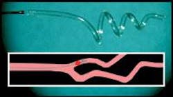 A polymer actuator changes from a straight rod to a corkscrew when channeling a few watts of near-IR laser light (top). The corkscrew shape may allow clots to be pulled from arteries (bottom). A polymer actuator changes from a straight rod to a corkscrew when channeling a few watts of near-IR laser light (top). The corkscrew shape may allow clots to be pulled from arteries (bottom).