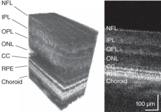FIGURE 3. A 3-D visualization (left) and a single B-scan (right) of microscopic retinal structure were obtained with AO FD-OCT. (NFL: nerve-fiber layer; IPL: inner plexiform layer; OPL: outer plexiform layer; ONL: outer nuclear layer; CC: connecting cilia; RPE: retinal pigment epithelium.) The lateral structure seen in the CC layer is due to the individual cone photoreceptors that are resolved in this image with a measured spacing of 10 &micro;m.