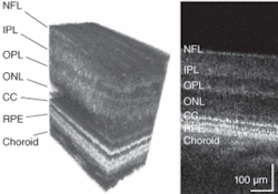 FIGURE 3. A 3-D visualization (left) and a single B-scan (right) of microscopic retinal structure were obtained with AO FD-OCT. (NFL: nerve-fiber layer; IPL: inner plexiform layer; OPL: outer plexiform layer; ONL: outer nuclear layer; CC: connecting cilia; RPE: retinal pigment epithelium.) The lateral structure seen in the CC layer is due to the individual cone photoreceptors that are resolved in this image with a measured spacing of 10 µm. FIGURE 3. A 3-D visualization (left) and a single B-scan (right) of microscopic retinal structure were obtained with AO FD-OCT. (NFL: nerve-fiber layer; IPL: inner plexiform layer; OPL: outer plexiform layer; ONL: outer nuclear layer; CC: connecting cilia; RPE: retinal pigment epithelium.) The lateral structure seen in the CC layer is due to the individual cone photoreceptors that are resolved in this image with a measured spacing of 10 µm.