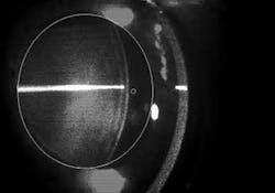 Quasi-elastic light scattering and fluorescent ligand scanning are used to measure amyloid protein aggregates in the lens of the eye. A cross section of the eye shows the incident laser beam used in the measurements. Quasi-elastic light scattering and fluorescent ligand scanning are used to measure amyloid protein aggregates in the lens of the eye. A cross section of the eye shows the incident laser beam used in the measurements.