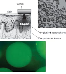FIGURE 1. Implantable fluorescent microspheres made of polyethylene glycol that have an assay chemistry specific to glucose that changes the fluorescence work in conjunction with an external optical biosensor (LED light source) to enable noninvasive glucose monitoring. FIGURE 1. Implantable fluorescent microspheres made of polyethylene glycol that have an assay chemistry specific to glucose that changes the fluorescence work in conjunction with an external optical biosensor (LED light source) to enable noninvasive glucose monitoring.