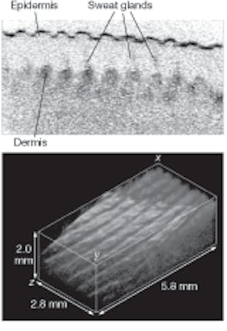 A human finger is imaged in vivo without horizontal scanning by using an axial-lateral parallel time-domain optical-coherence-tomography technique (top) at an acquisition rate of 1/1500 s to gather 512 x 512-pixel image information. Horizontal scanning then allows capture and computation of a 3-D image (bottom) that represents a total volume of 5.8 x 2.8 x 2.0 mm3.