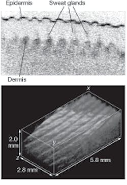 A human finger is imaged in vivo without horizontal scanning by using an axial-lateral parallel time-domain optical-coherence-tomography technique (top) at an acquisition rate of 1/1500 s to gather 512 x 512-pixel image information. Horizontal scanning then allows capture and computation of a 3-D image (bottom) that represents a total volume of 5.8 x 2.8 x 2.0 mm3. A human finger is imaged in vivo without horizontal scanning by using an axial-lateral parallel time-domain optical-coherence-tomography technique (top) at an acquisition rate of 1/1500 s to gather 512 x 512-pixel image information. Horizontal scanning then allows capture and computation of a 3-D image (bottom) that represents a total volume of 5.8 x 2.8 x 2.0 mm3.