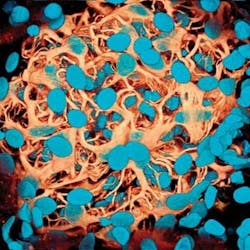 FIGURE 1. In a multiphoton-microscopy image of mature glomerulus from an adult rat, podocytes are labeled with antivimetin (brown) and the nuclei with DAPI (blue). This image was taken using a Spectra-Physics femtosecond Ti:sapphire laser (Mai Tai) tuned to 800 nm. FIGURE 1. In a multiphoton-microscopy image of mature glomerulus from an adult rat, podocytes are labeled with antivimetin (brown) and the nuclei with DAPI (blue). This image was taken using a Spectra-Physics femtosecond Ti:sapphire laser (Mai Tai) tuned to 800 nm.