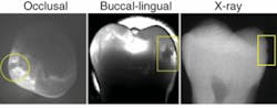 FIGURE 4. When an NIR image of a tooth (left and center) is compared with an x-ray image (right), decay that is clearly visible in the NIR image is barely noticeable in the x-ray. In addition, the NIR system can image from multiple angles, including top-down (left), to provide even more information about location and depth. FIGURE 4. When an NIR image of a tooth (left and center) is compared with an x-ray image (right), decay that is clearly visible in the NIR image is barely noticeable in the x-ray. In addition, the NIR system can image from multiple angles, including top-down (left), to provide even more information about location and depth.