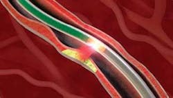 FIGURE 2. The InfraReDx system, designed to assess vulnerable plaque in coronary arteries during angioplasty, can obtain 100 NIR spectroscopic measurements/s within an artery. FIGURE 2. The InfraReDx system, designed to assess vulnerable plaque in coronary arteries during angioplasty, can obtain 100 NIR spectroscopic measurements/s within an artery.