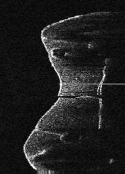 The 1310 nm OCT Dental Imaging System from Lantis Laser can image across the occlusal surface of a molar to detect a composite filling with cracks on the side, plus delamination and voids. The 1310 nm OCT Dental Imaging System from Lantis Laser can image across the occlusal surface of a molar to detect a composite filling with cracks on the side, plus delamination and voids.
