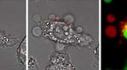 When nanorods containing folic acid are exposed to near-IR laser light, they heat up and induce blebs in the membranes of an adjacent cancer cell. Images left and center show the nanorods (red spots) before and after irradiation, respectively. The resulting opening of the membrane (red) can be seen (right), as well as an elevation in intracellular calcium ions that leads to production of the blebs.