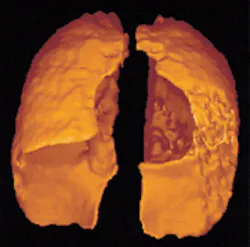 Hyperpolarized gas filling the lungs provides a three-dimensional view of the airflow within them. Hyperpolarized gas filling the lungs provides a three-dimensional view of the airflow within them.