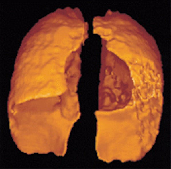 Hyperpolarized gas filling the lungs provides a three-dimensional view of the airflow within them.