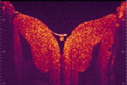 Images of brain tissue from a frog (with the skull removed) were obtained in real time (12 frames/s) with a resolution of 15 µm in the range dimension and 25 µm in the lateral dimension. Images of brain tissue from a frog (with the skull removed) were obtained in real time (12 frames/s) with a resolution of 15 µm in the range dimension and 25 µm in the lateral dimension.