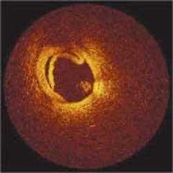 The focus of an optical-computed-tomography startup company, LightLab Imaging (Littleton, MA), is on facilitating earlier and more-accurate diagnosis of a wide range of diseases, including heart disease and cancer. This image is of a human coronary dissection. The focus of an optical-computed-tomography startup company, LightLab Imaging (Littleton, MA), is on facilitating earlier and more-accurate diagnosis of a wide range of diseases, including heart disease and cancer. This image is of a human coronary dissection.