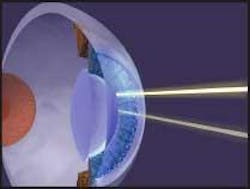 Unlike in conventional excimer laser surgery for vision correction, ultrafast laser pulses ablate material within the cornea without the need to cut an external flap. Unlike in conventional excimer laser surgery for vision correction, ultrafast laser pulses ablate material within the cornea without the need to cut an external flap.