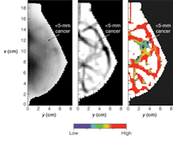FIGURE 3. In oblique-view, right-breast (r-ob) diffusion optical mammogram of a patient with an invasive ductal carcinoma smaller than 5 mm in size (at arrow), an optical-density image is corrected for variable breast thickness over the image (left), spatial second-derivative image with enhanced contast (middle) was obtained from an optical-density image, and an oxygenation image (right) obtained from second-derivative images at four wavelengths offers hemoglobin-concentration maps with color coding of hypoxic areas. FIGURE 3. In oblique-view, right-breast (r-ob) diffusion optical mammogram of a patient with an invasive ductal carcinoma smaller than 5 mm in size (at arrow), an optical-density image is corrected for variable breast thickness over the image (left), spatial second-derivative image with enhanced contast (middle) was obtained from an optical-density image, and an oxygenation image (right) obtained from second-derivative images at four wavelengths offers hemoglobin-concentration maps with color coding of hypoxic areas.