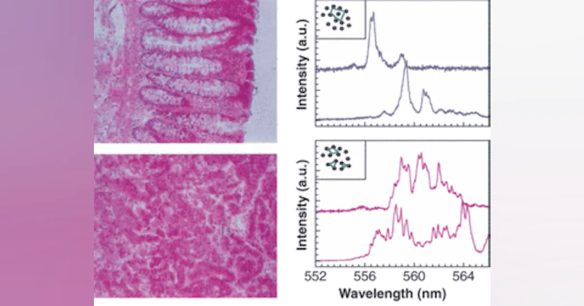 Ruby Lasing Medium Dye turns cancer tissue into lasing medium | Laser Focus World