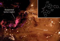 FIGURE 2. In the BiOS 2005 program on nano- and biophotonics, Darryl Bornhop and his team will discuss novel molecular imaging agents used for enhanced disease detection in the body. For example, fluorescence from Eu3+-PK 11195 can highlight a tumor in the brain of a rat. FIGURE 2. In the BiOS 2005 program on nano- and biophotonics, Darryl Bornhop and his team will discuss novel molecular imaging agents used for enhanced disease detection in the body. For example, fluorescence from Eu3+-PK 11195 can highlight a tumor in the brain of a rat.