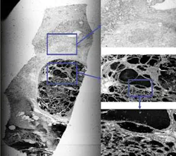 A large-image-area laser-confocal microscope can capture many types of images. Monochrome transmitted-light (top) and autofluorescence (bottom) images were obtained of an unstained ovarian tumor section, both at an optical resolution of 2 µm. The 10 × 30-mm specimen was scanned with 532-nm laser light. The transmitted-light image was enhanced with equalization contrast, while the fluorescent image was enhanced with logarithmic contrast and a false-color palette. The specimen was provided by David Hedley of the Princess Margaret Hospital (Toronto, Ont., Canada). The microscope can also produce full-color images.