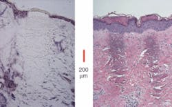 FIGURE 4. Histology cross sections (200 ìm) of deep, narrow lesions created by the Fraxel fiber-laser resurfacing system show how the beam quality of the laser denatures the dermis in a needle-like projection that does not kill the surface tissue. A section of tissue excised immediately after treatment (left) shows the viable (darker stained), spared regions of the epidermis on both sides of the nonviable (washed out) treatment zone extending down through the epidermis and dermis. The protective stratum corneum at the very top is nonviable, but intact. A stained section of tissue excised three days post treatment (right) shows the full regrowth of the epidermis. Below that is the denatured tissue that will be remodeled over a period of weeks to months. FIGURE 4. Histology cross sections (200 ìm) of deep, narrow lesions created by the Fraxel fiber-laser resurfacing system show how the beam quality of the laser denatures the dermis in a needle-like projection that does not kill the surface tissue. A section of tissue excised immediately after treatment (left) shows the viable (darker stained), spared regions of the epidermis on both sides of the nonviable (washed out) treatment zone extending down through the epidermis and dermis. The protective stratum corneum at the very top is nonviable, but intact. A stained section of tissue excised three days post treatment (right) shows the full regrowth of the epidermis. Below that is the denatured tissue that will be remodeled over a period of weeks to months.