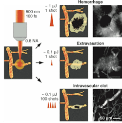 FIGURE 3. Femtosecond pulses focused onto blood vessels in rat brains simulate different types of strokes. High-energy pulses trigger a hemorrhage. Single low-energy pulses can cause small blood leakage, and a series of pulses can produce a clot blocking the blood vessel. FIGURE 3. Femtosecond pulses focused onto blood vessels in rat brains simulate different types of strokes. High-energy pulses trigger a hemorrhage. Single low-energy pulses can cause small blood leakage, and a series of pulses can produce a clot blocking the blood vessel.