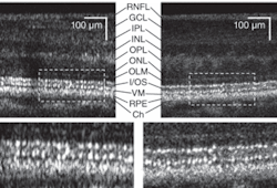 FIGURE 2. An ultrabroadband superluminescent diode improves resolution in images of a 0.5 mm section of a healthy retina. The improved AO-UHR-OCT system incorporated a source with 3.5 &micro;m axial resolution in tissue (dashed rectangle, top right, magnified in bottom right), which shows reduced speckle size in comparison with an AO-OCT system with 6.5 &micro;m axial resolution (dashed rectangle, top left, magnified in bottom left).